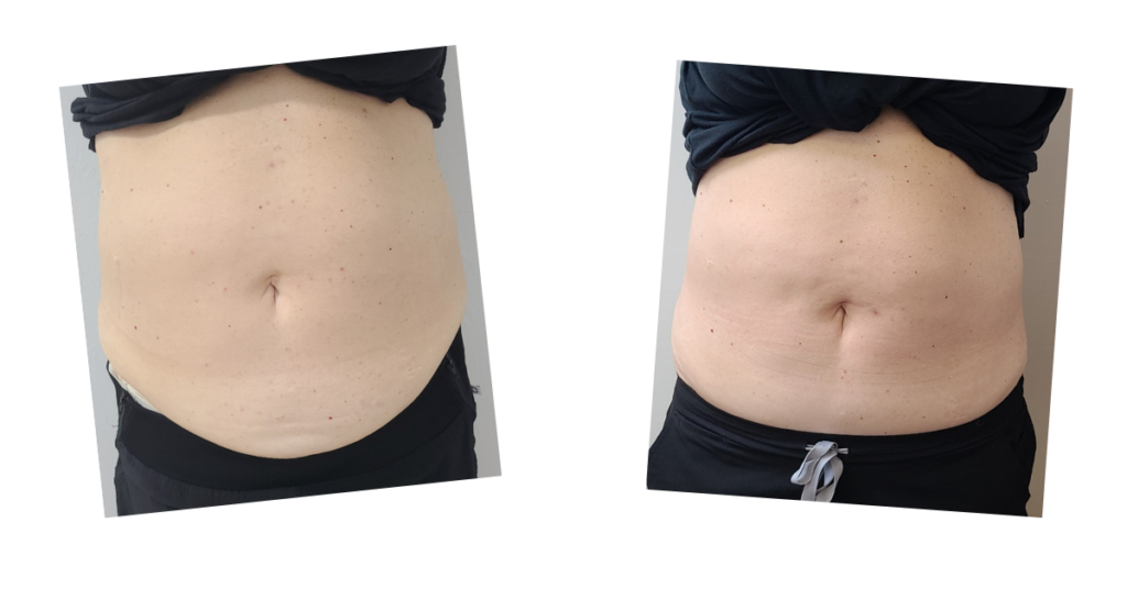 Before and after result of Emerald laser treatment on a stomach