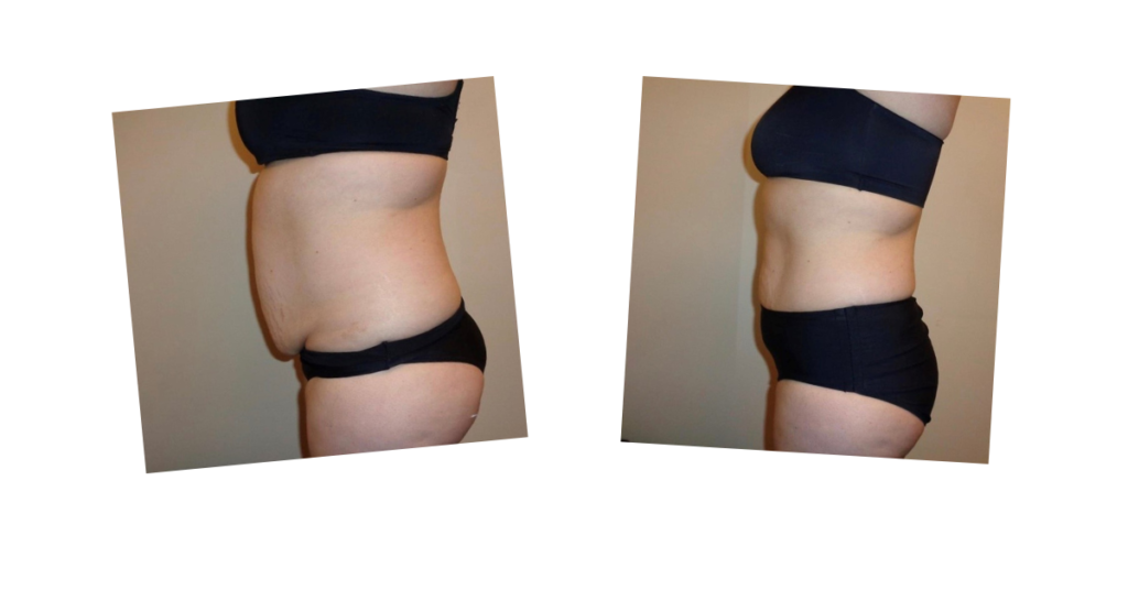 Before and after photos of fat loss on a stomach from the Emerald laser treatment