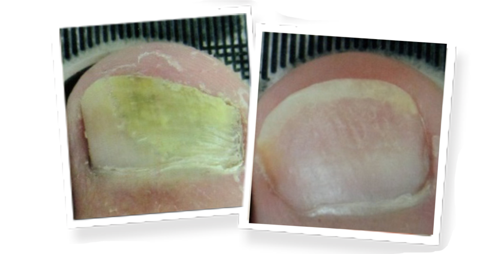 Before and after laser treatment photos of a toe with fungus