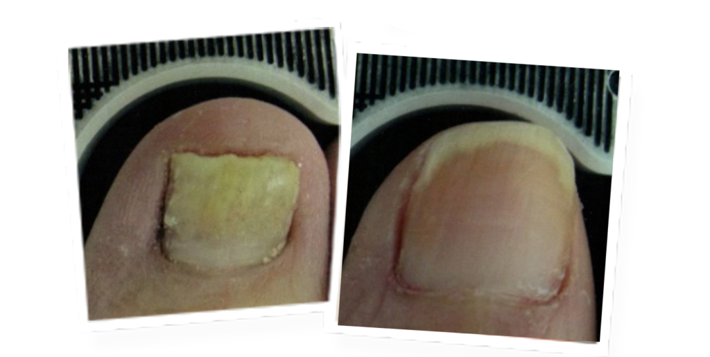 Before and after laser treatment photos of a toe with fungus